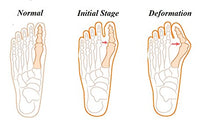 Charger l'image dans la galerie, Happystep 3-in-1 Bunion Kit, 1 Pair Splints +1 Pair Toe Separators + Elastic Strap for Hallux Valgus, Bunion Pain Relief, Toe Alignment, for Men, Women Washable